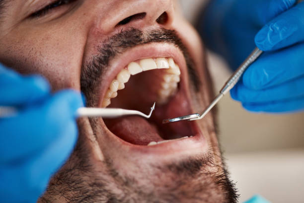 Best Emergency Treatment for Dental Infections or Abscesses in Whitemarsh Island, GA
